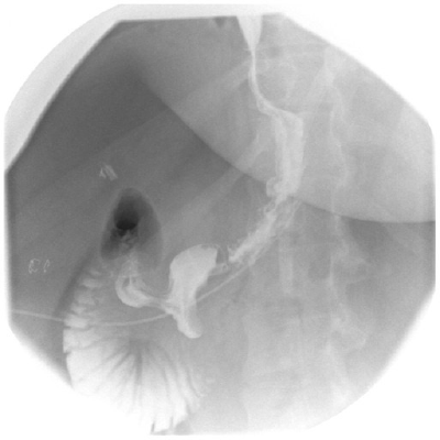 Fluoroscopy post-gastric sleeve example